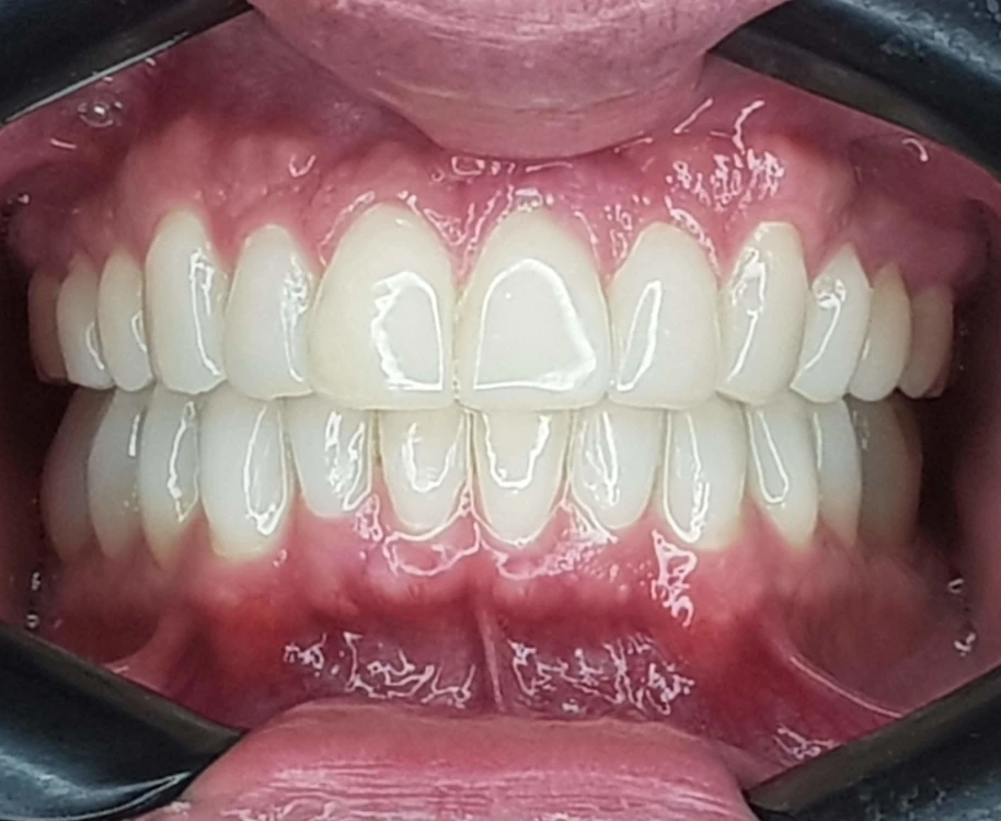 Alinhamento dentário com resina no Tatuapé — Sannre Odontologia