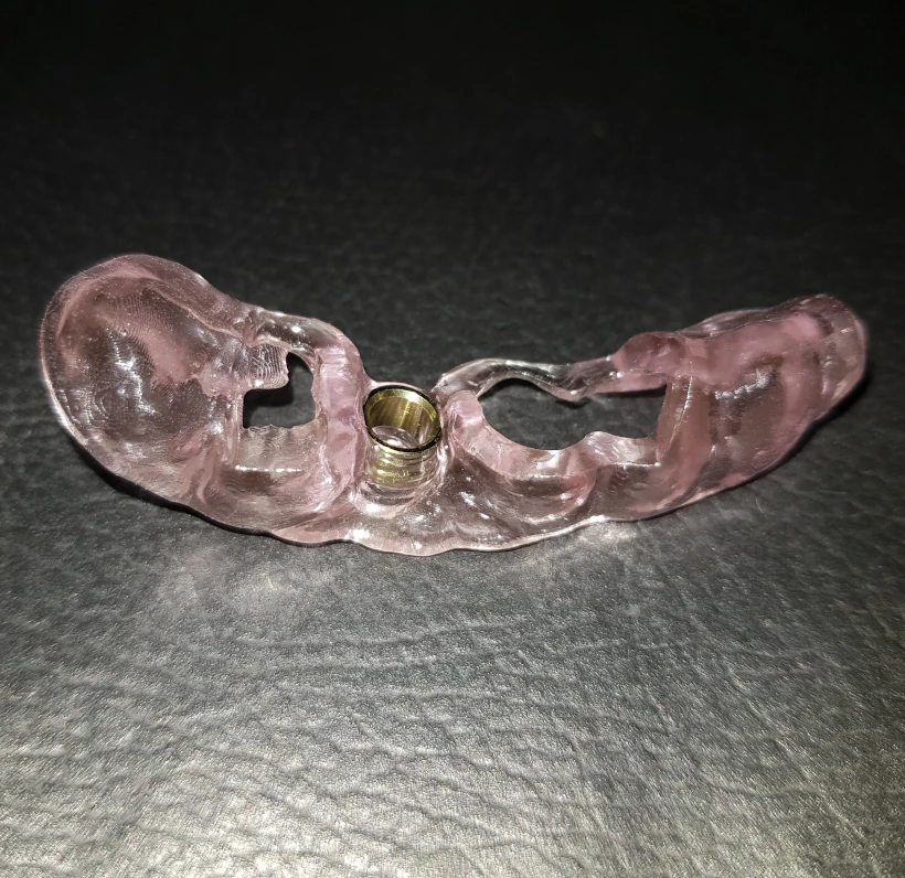 Cirurgia Guiada de Implante no Tatuapé — Sannre Odontologia