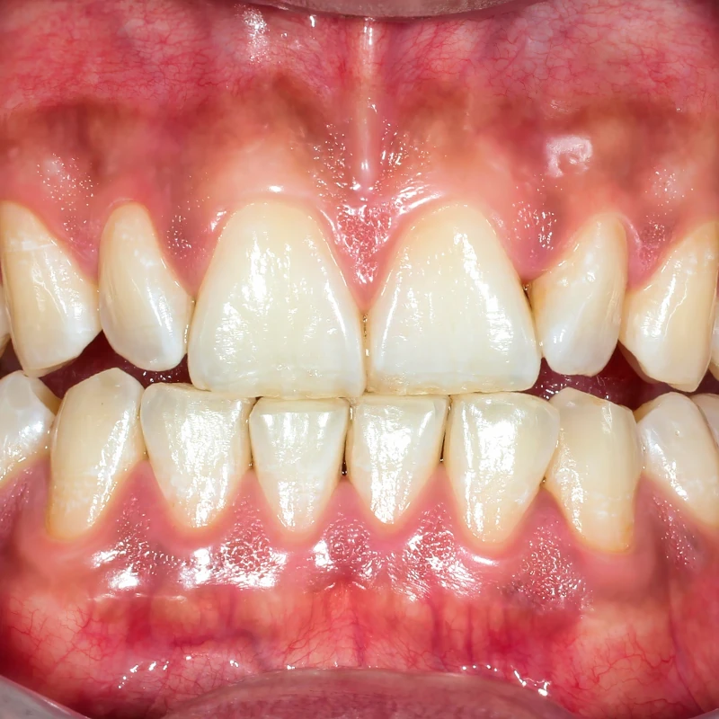 Tratamento de gengivite no Tatuapé — Sannre Odontologia