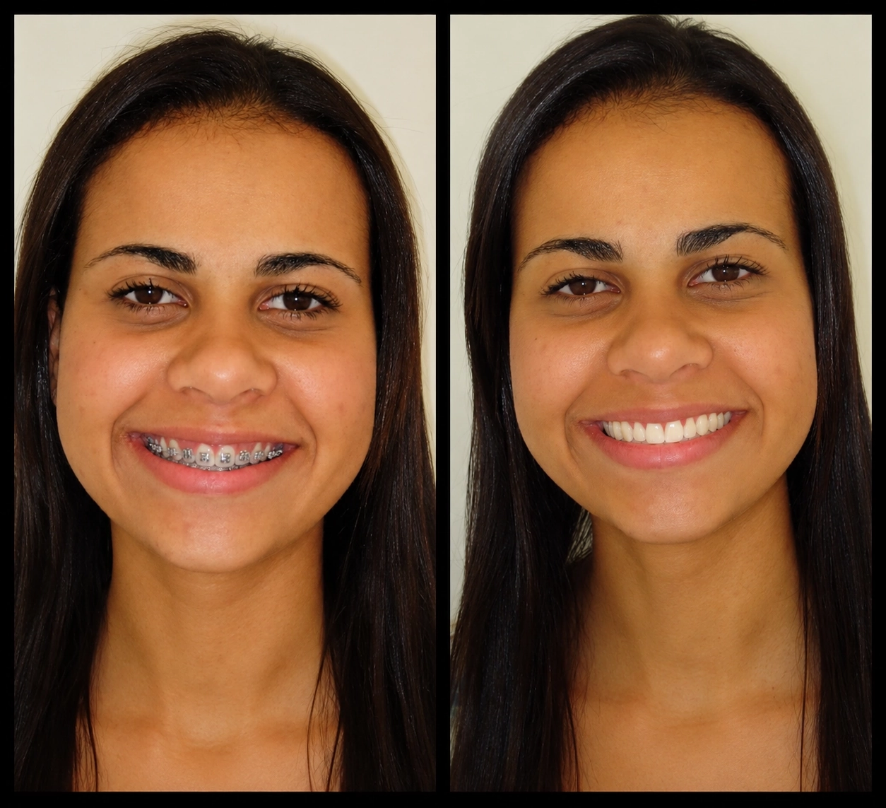 Gengivoplastia no Tatuapé — Sannre Odontologia