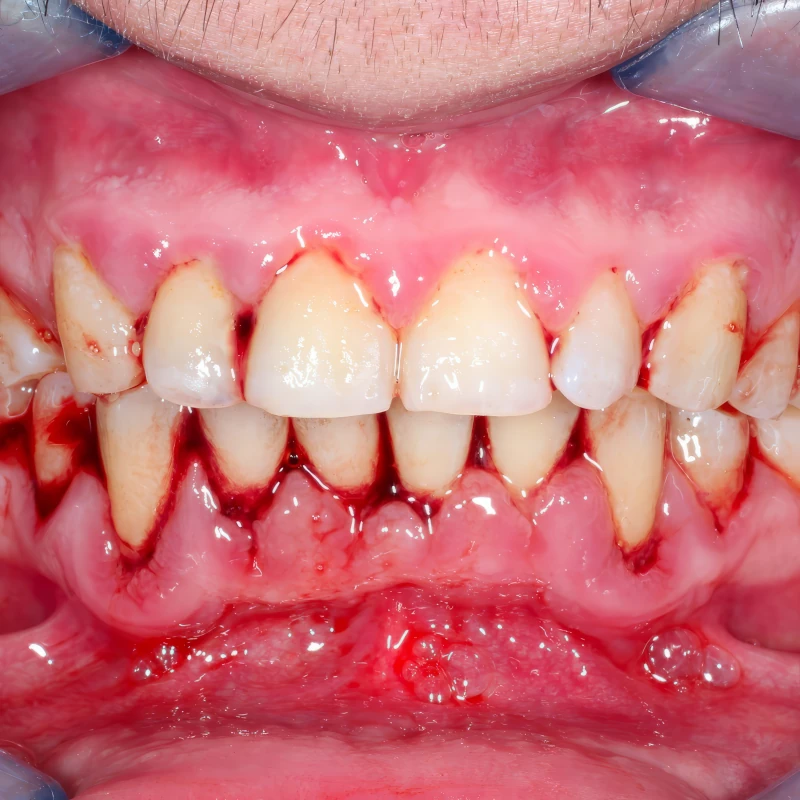 Tratamento de retração gengival no Tatuapé — Sannre Odontologia